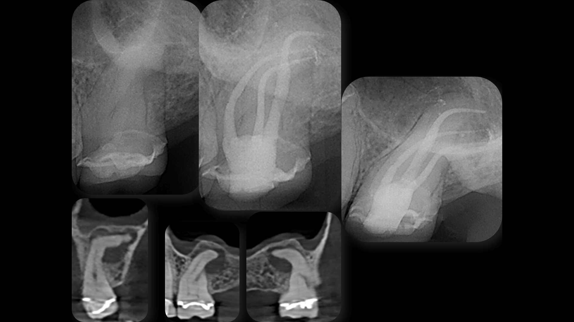 Broken Instrument Removal - Case 6